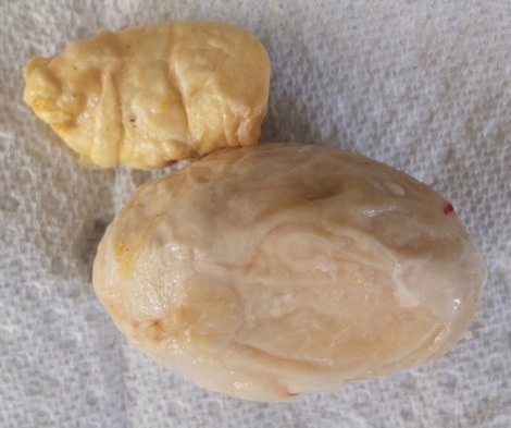 Two Salpingitis Masses Found In Corazon's Reproductive Tract